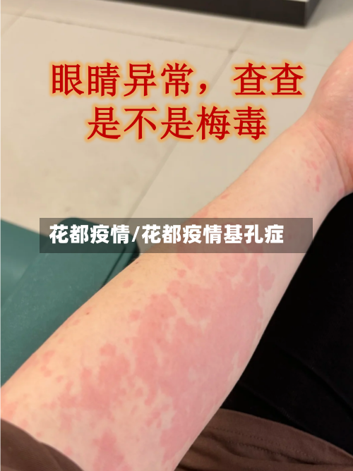 花都疫情/花都疫情基孔症