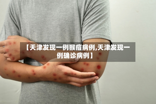 【天津发现一例猴痘病例,天津发现一例确诊病例】-第2张图片
