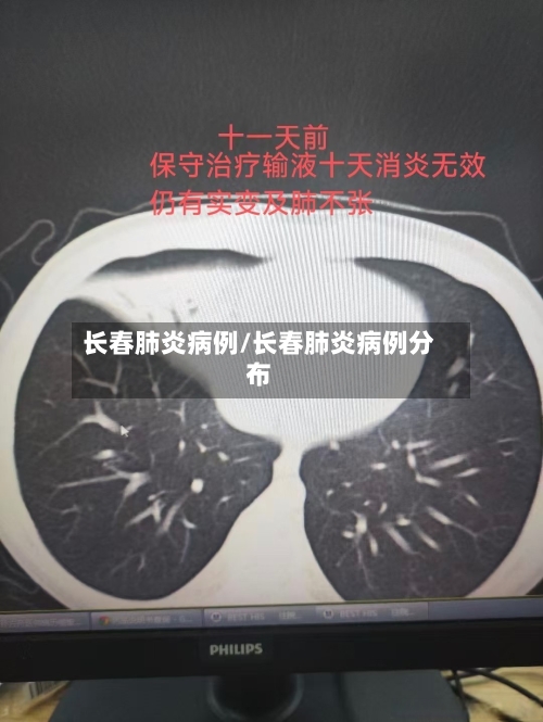 长春肺炎病例/长春肺炎病例分布-第2张图片