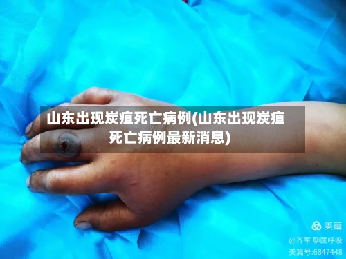 山东出现炭疽死亡病例(山东出现炭疽死亡病例最新消息)