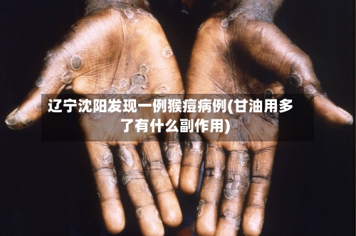 辽宁沈阳发现一例猴痘病例(甘油用多了有什么副作用)